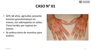 CASO N° 01
• GFR, 60 años, agricultor, presenta
lesiones granulomatosas en
manos, con adenopatías en axilas.
Tiene heridas por espinas en
manos.
• Se ordena toma de muestras para
análisis.
30/05/2020 38
 