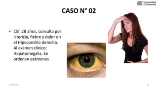 CASO N° 02
• CST, 28 años, consulta por
ictericia, fiebre y dolor en
el Hipocondrio derecho.
Al examen clínico:
Hepatomegalia. Se
ordenan exámenes
30/05/2020 75
 