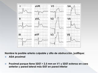 Nombre la posible arteria culpable y sitio de obstrucción, justifique:
 ADA proximal


Proximal porque tiene SDST > 2.5 mm en V1 y SDST extenso en cara
anterior y pared lateral más IDST en pared inferior

 