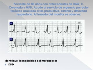 Identifique la modalidad del marcapasos
 DDD

 