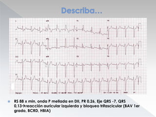 

RS 88 x min, onda P mellada en DII, PR 0.26, Eje QRS -7, QRS
0,13reacción auricular izquierda y bloqueo trifascicular (BAV 1er
grado, BCRD, HBIA)

 