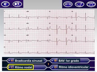 Bradicardia sinusal

BAV 1er grado

Ritmo nodal

Ritmo idioventricular

 