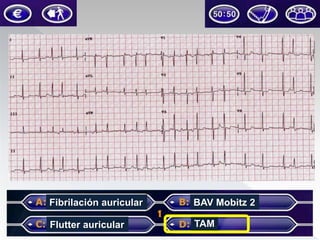 Fibrilación auricular

BAV Mobitz 2

Flutter auricular

TAM

 