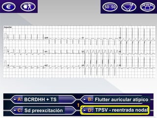 BCRDHH + TS

Flutter auricular atípico

Sd preexcitación

TPSV - reentrada nodal

 