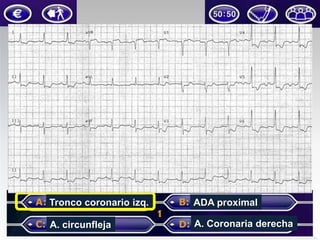 Tronco coronario izq.

ADA proximal

A. circunfleja

A. Coronaria derecha

 