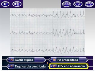 BCRD atípico

FA preexcitada

Taquicardia ventricular

TSV con aberrancia

 