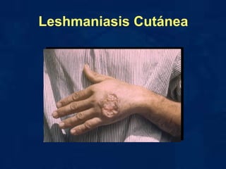 Leshmaniasis Cutánea 