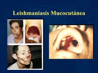 Leishmaniasis Mucocutánea 