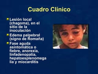 Cuadro Clínico Lesión local (chagoma), en el sitio de la inoculación Edema palpebral (signo de Romaña) Fase aguda asintomática o fiebre, anorexia, linfadenopatía, hepatoesplenomegalia y miocarditis 