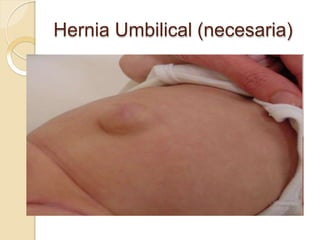 Hernia Umbilical (necesaria)
 