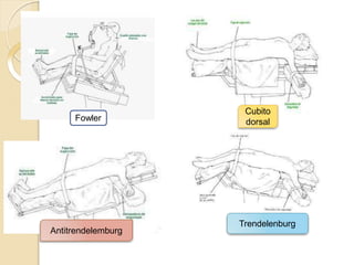 Cubito
dorsal
Fowler
Antitrendelemburg
Trendelenburg
 