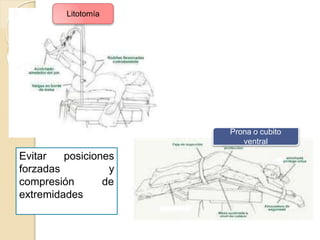 Evitar
forzadas
posiciones
y
compresión de
extremidades
Litotomía
Prona o cubito
ventral
 