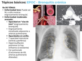 Endolumin SESIÓN 04 - Parte 1 - Tórax.pdf imagenologia | PDF