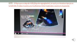 E.T.T. : ElflujoquesealejadeV.IZQ.(flujoderegurgitación),enazulyseintroducetipojeten
laAUR.IZQ.Elvideomuestraunainsuficienciamitralmoderadaaseveraenelpaciente.
 