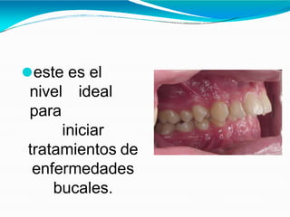⚫este es el
nivel ideal
para
iniciar
tratamientos de
enfermedades
bucales.
 