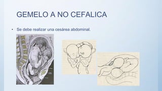 GEMELO A NO CEFALICA
• Se debe realizar una cesárea abdominal.
 