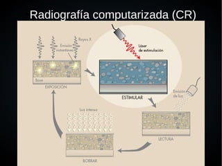 ●
Radiografía computarizada (CR)
 