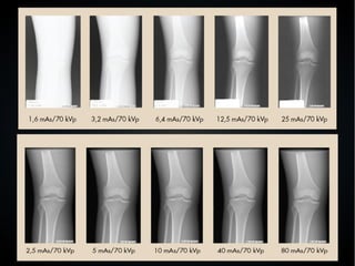 ●
Radiografía computarizada (CR)
 