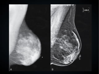 ●
Radiografía digital (RD)
 