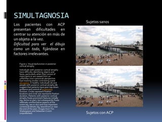 SIMULTAGNOSIA
Figure 1. Visual dysfunction in posterior
cortical atrophy
Individuals with posterior cortical atrophy
have difficulty identifying objects and
faces, particularly when they consist of
many parts or are viewed from an
unfamiliar (non-canonical) perspective.
Eye-tracking studies contrasting scene
perception in healthy individuals (A) and
people with posterior cortical atrophy (B)
suggest that patients have poor top-down
guidance and control of oculomotor
function. Circles represent fixation
locations and circle size represents fixation
duration. Patients with posterior cortical
atrophy fixate prominent features initially
(eg, dome on pier), but subsequently fixate
relatively uninformative aspects of the
scene (eg, sea or sky) and miss important
contextual details (eg, beachfront or near
the end of the pier). Images from Tim
Shakespeare and Sebastian Crutch
(unpublished)
Los pacientes con ACP
presentan dificultades en
centrar su atención en más de
un objeto a la vez.
Dificultad para ver el dibujo
como un todo, fijándose en
factores irrelevantes.
Sujetos sanos
Sujetos con ACP
 