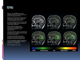 RMN
Figure 2. Annual MRI scans on an
individual with PCA. Each repeat scan
was fluid-registered to the
baseline scan and colour-coded voxel-
compression maps were produced
showing saggital sections from
the right hemisphere. The colour scale
shows percentage volume change per
voxel (20%–20%) with
green and blue representing
contraction and yellow and red
representing expansion. This
retrospective
analysis revealed superior parietal lobe
and temporo-occipital junction atrophy
as early as the second
assessment (B), inferior parietal,
occipital and inferior temporal lobe
atrophy from the third assessment
(C) and subsequent global atrophy but
with a continuing posterior-anterior
gradient (D–F). (Adapted
from Kennedy et al., 2012).
 
