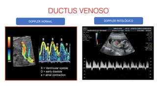 DUCTUS VENOSO
DOPPLER NORMAL DOPPLER PATOLÓGICO
 