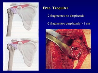 Frac. Troquiter -2 fragmentos no desplazado -2 fragmentos desplazada > 1 cm 