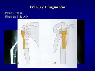 Frac. 3 y 4 fragmentos -Placa Titania. -Placa en T de AO. 