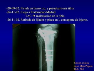 -20-09-02. Fístula en brazo izq. y pseudoartrosis tibia. -04-11-02. Llega a Fraternidad-Madrid. TAC    malrotación de la ...