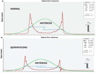 NORMAL
QUERATOCONO
HISTÉRESIS
HISTÉRESIS
 