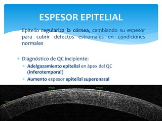  Epitelio regulariza la córnea, cambiando su espesor
para cubrir defectos estromales en condiciones
normales
 Diagnóstico de QC incipiente:
 Adelgazamiento epitelial en ápex del QC
(inferotemporal)
 Aumento espesor epitelial superonasal
ESPESOR EPITELIAL
 