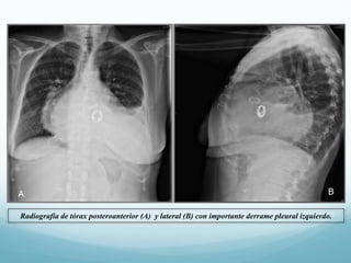 A

B

Radiografía de tórax posteroanterior (A) y lateral (B) con importante derrame pleural izquierdo.

 