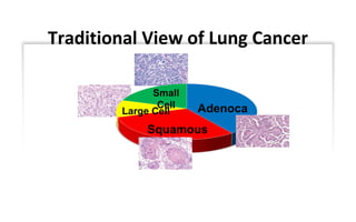 Traditional View of Lung Cancer
Adenoca
Small
Cell
Large Cell
Squamous
 