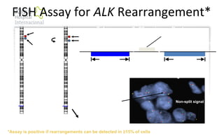 ~250 kb ~300 kb
t(2;5) ALK gene
breakpoint region
2p23 regionTelomere Centromere
3’ 5’
FISH Assay for ALK Rearrangement*
Break-apart FISH assay
for ALK-fusion genes1
ALK 29.3
EML4 42.3
ALK break-apart FISH assay
[Courtesy John Iafrate, Massachusetts General Hospital]
1
Shaw AT et al. J Clin Oncol
2009;27:4247–4253
q36.1
q36.3
q37.2
q34
q32.1
q32.3
q33.2
q31.3
q24.3
q24.1
q23.2
q22.2
q22.1
q21.2
q14.3
q14.1
q12.3
q12.1
p12
p13.2
p14
p16.1
p16.3
p22.1
p23.2
p22.3
p24.1
p24.3
p25.2
q36.1
q36.3
q37.2
q34
q32.1
q32.3
q33.2
q31.3
q24.3
q24.1
q23.2
q22.2
q22.1
q21.2
q14.3
q14.1
q12.3
q12.1
p12
p13.2
p14
p16.1
p16.3
p22.1
p23.2
p22.3
p24.1
p24.3
p25.2
Split signal
Non-split signal
*Assay is positive if rearrangements can be detected in ≥15% of cells
FISH = fluorescence in situ hybridization
 