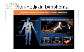 Non-Hodgkin Lymphoma
 