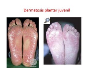 Dermatosis plantar juvenil
 