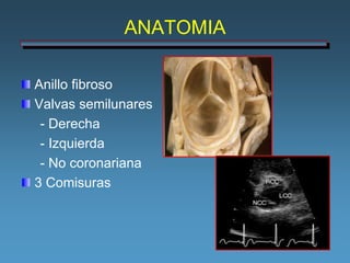 ANATOMIA

Anillo fibroso
Valvas semilunares
 - Derecha
 - Izquierda
 - No coronariana
3 Comisuras
 