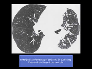 Linfangitis carcinomatosa por carcinoma en pulmón izq.
Engrosamiento liso peribroncovascular
 