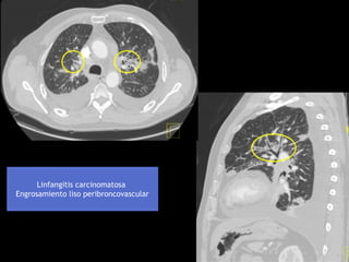 Linfangitis carcinomatosa
Engrosamiento liso peribroncovascular
 