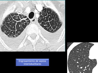 Engrosamiento de septos
interlobulillares
 