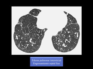 Edema pulmonar intersticial
Engrosamiento septal liso
 