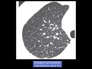 Linfangitis carcinomatosa
Engrosamiento septal liso
 