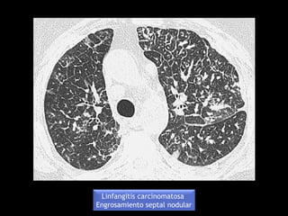 Linfangitis carcinomatosa
Engrosamiento septal nodular
 