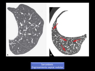 Sarcoidosis
Engrosamiento septal nodular
 