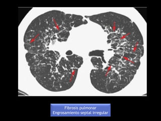 Fibrosis pulmonar
Engrosamiento septal irregular
 