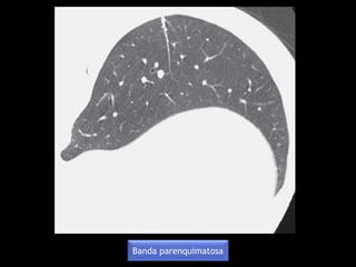 Banda parenquimatosa
 