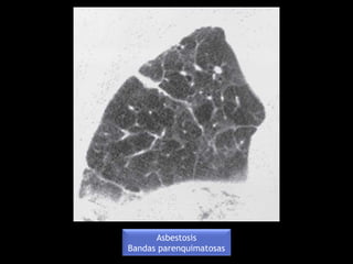 Asbestosis
Bandas parenquimatosas
 