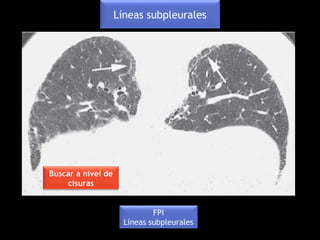 FPI
Líneas subpleurales
Buscar a nivel de
cisuras
Líneas subpleurales
 