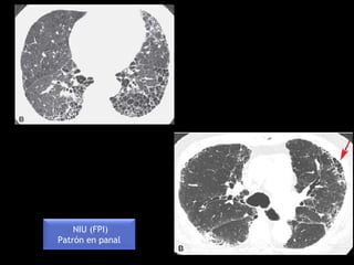 NIU (FPI)
Patrón en panal
 