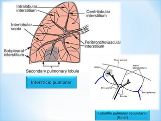 Lobulillo pulmonar secundario
(Miller)
Intersticio pulmonar
 